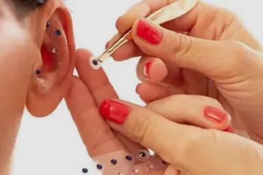 Foto auricoloterapia
